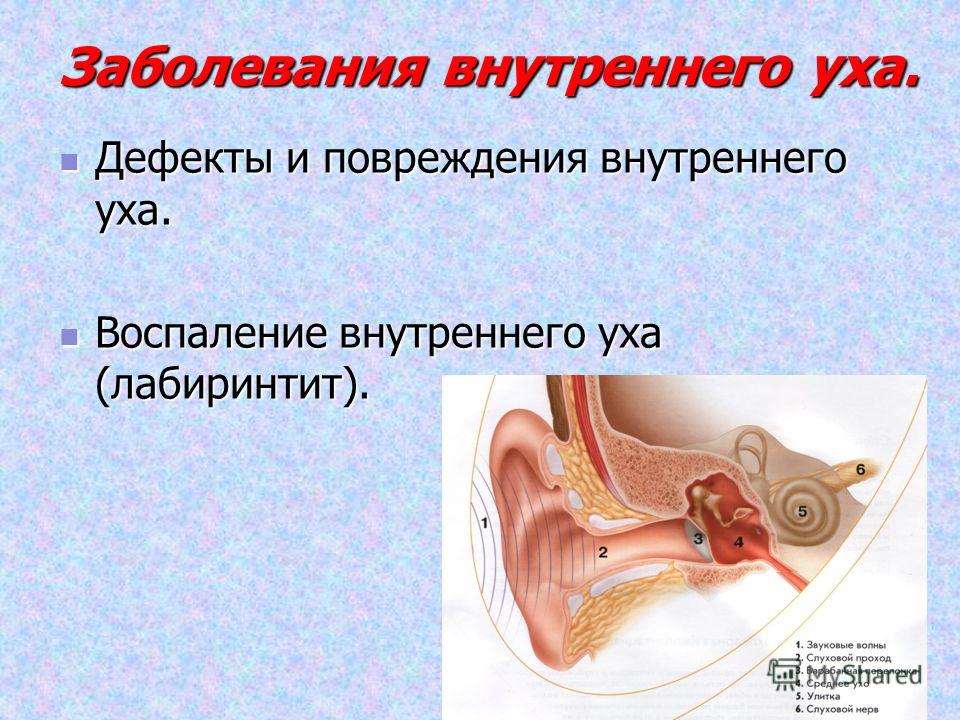 Воспаление внутреннего уха лабиринтит. Внутреннее ухо заболевания. Патологии среднего уха.