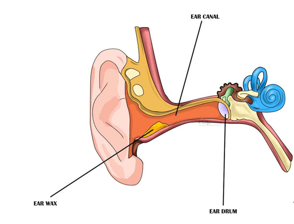 Хлюпает вода в ухе. Хлюпает барабанная перепонка в ухе. Наложение турунды в наружный слуховой канал.