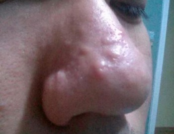 Акне на носу