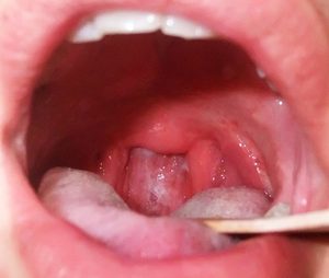 Зуд в горле - симптом воспалительного процесса