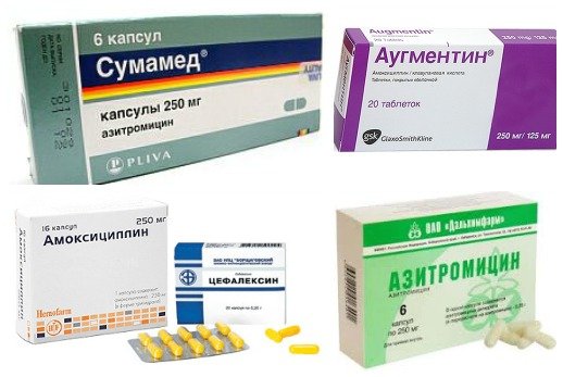 Антибиотики при стрептококковой инфекции в горле