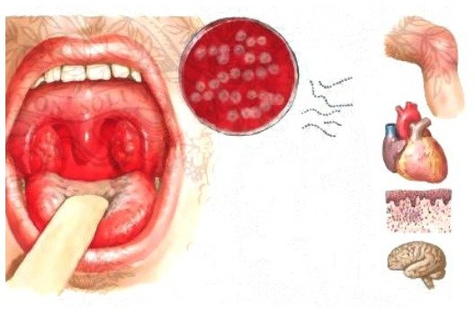 Осложнения стрептококковой инфекции горла
