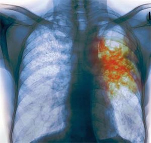 Рентген легких при туберкулезе