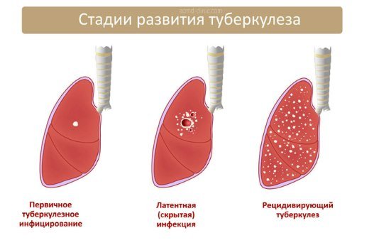 Этапы развития туберкулеза