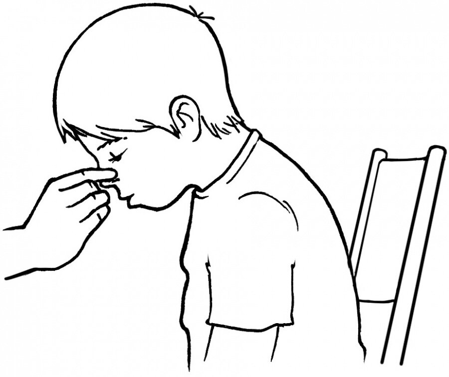 При носовом кровотечении наклонить голову. Носовое кровотечение у детей. Носовое кровотечение рисунок.