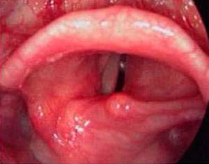 Симптомы и лечение аллергии в горле