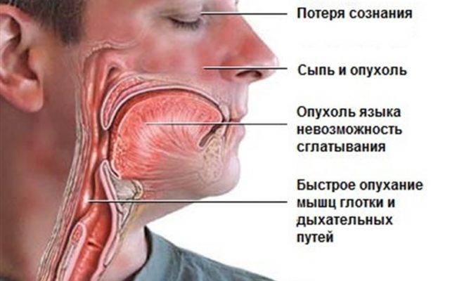 Симптомы и лечение аллергии в горле