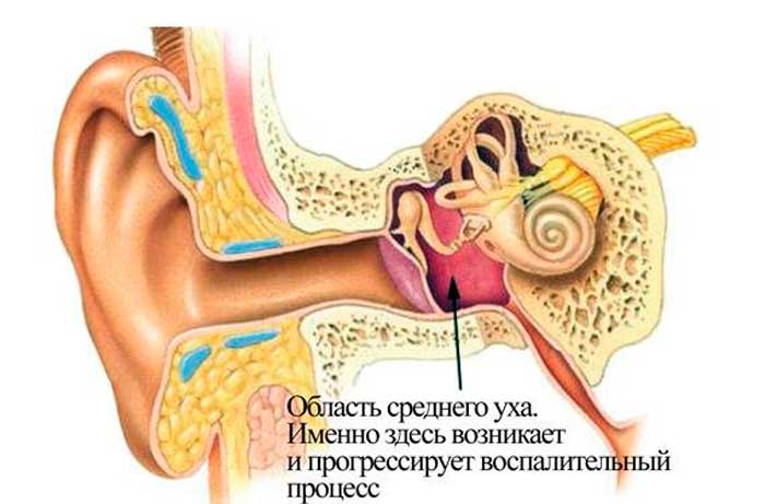 воспалительный процесс в зоне среднего уха