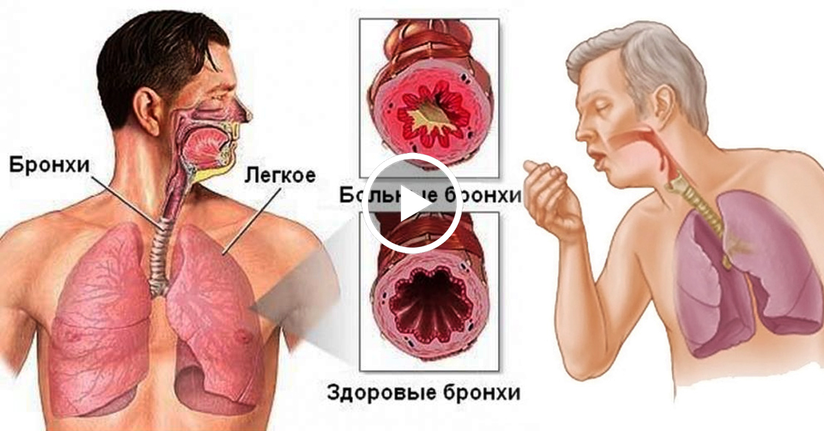 Хронический бронхит и астма