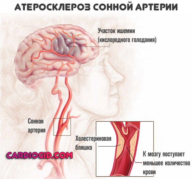 атеросклероз-сонной-артерии