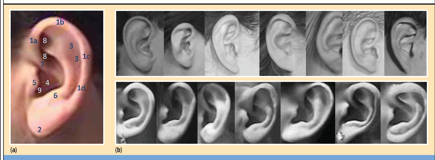 Квадробика уши. Микротия ушной раковины 4. Противокозелок ушной раковины. Козелок ушной раковины формы. Отопластика (1 ушная раковина).