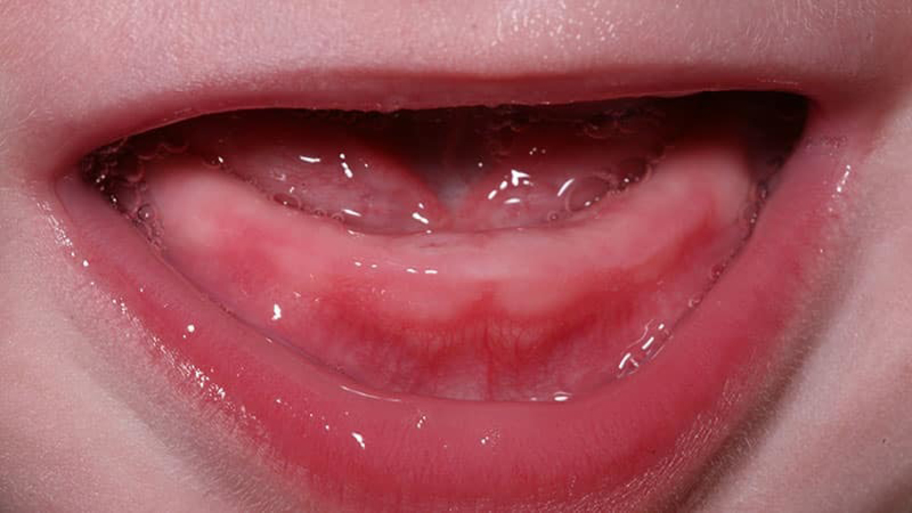Отек при прорезывании зубов приносит дискомфорт и вызывает кашель у ребенка