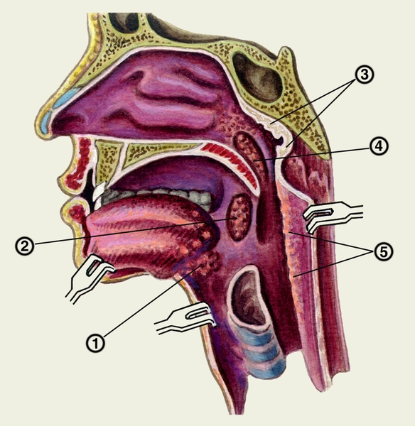 Схематическое изображение миндалин на сагиттальном разрезе через полости носа, рта и глотки: 1 — язычная миндалина; 2 — небная миндалина; 3 — глоточная миндалина; 4 — трубная миндалина; 5 — лимфатические фолликулы, рассеянные в слизистой оболочке задней стенки глотки