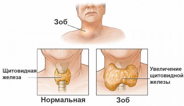 основные симптомы увеличения щитовидной железы у мужчин