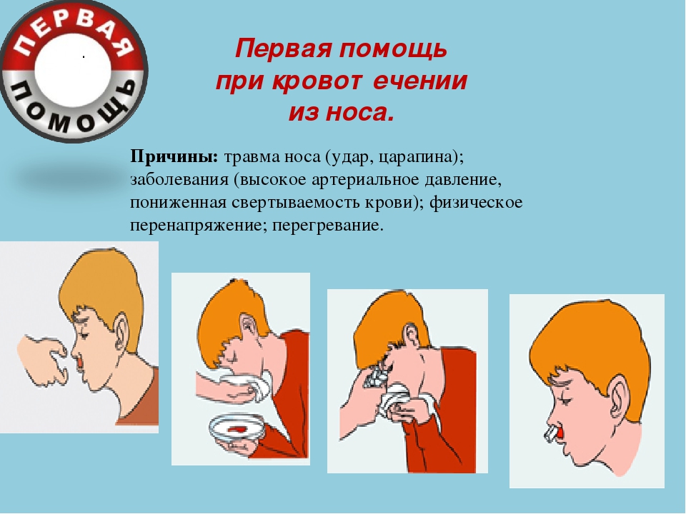 С носовым кровотечением следует. Первая помощь при кровотечении из носа. Оказание помощи при кровотечении из носа. При кровотечении из носа. Оказание первой помощи при травме носа.