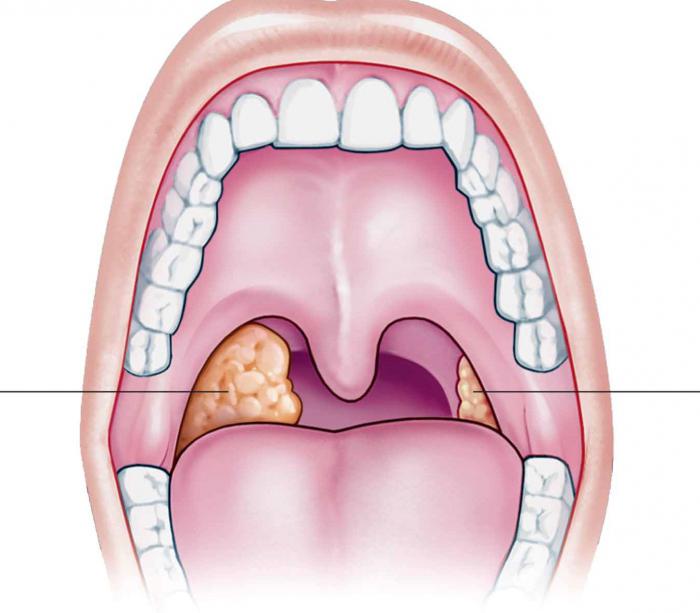 удаление миндалин при хроническом тонзиллите
