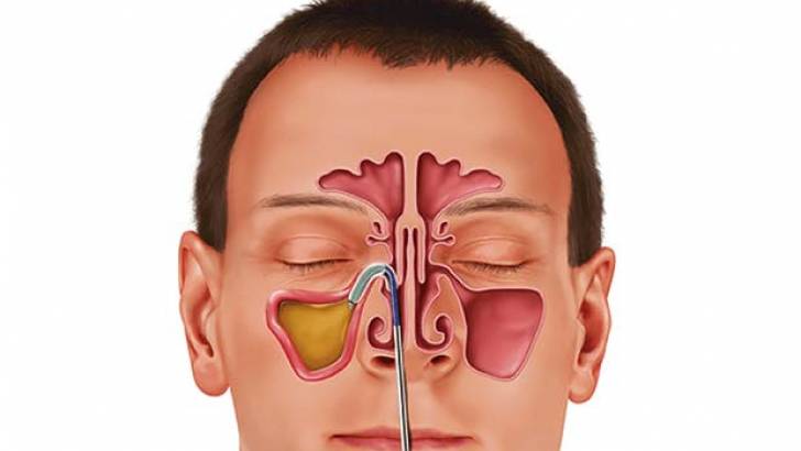 заболевания носа и околоносовых пазух