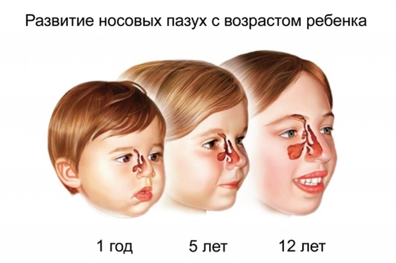 Формирование носовых пазух у детей по возрастам