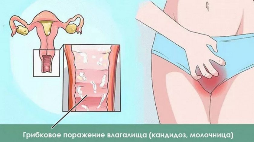 Клюква при молочнице