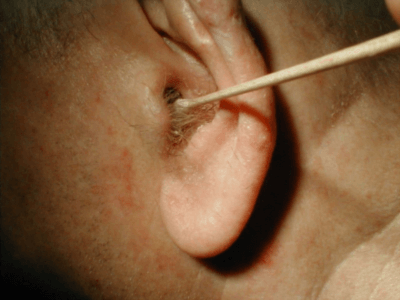 Наружный диффузный отит может возникнуть после неправильного удаления ушной серы