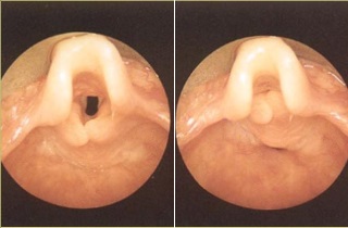 Как диагностировать синдром надгортанника