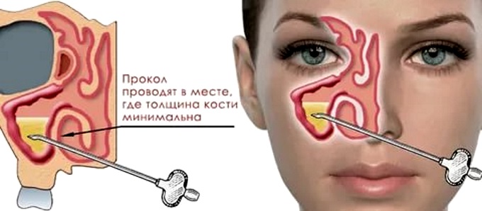 Как вылечить инфекцию в носу