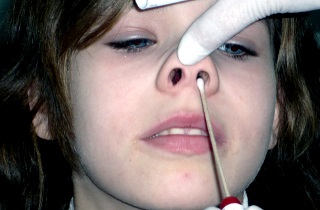 Домашнее лечение полипов в носу