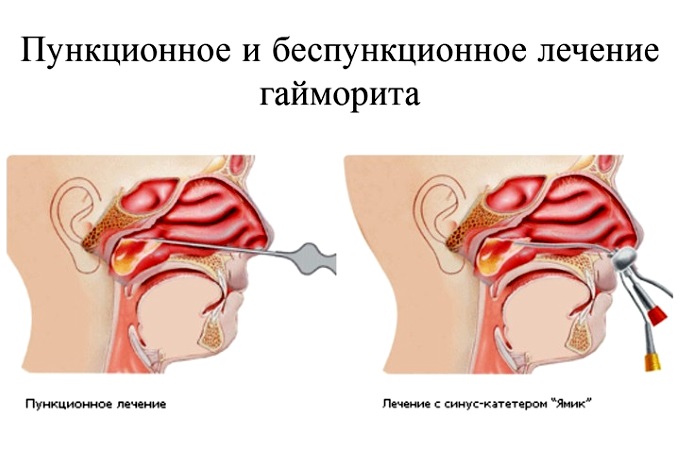 Оперативное лечение желтых соплей