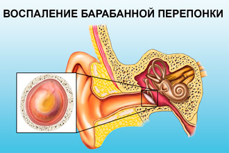 Воспаленная барабанная перепонка