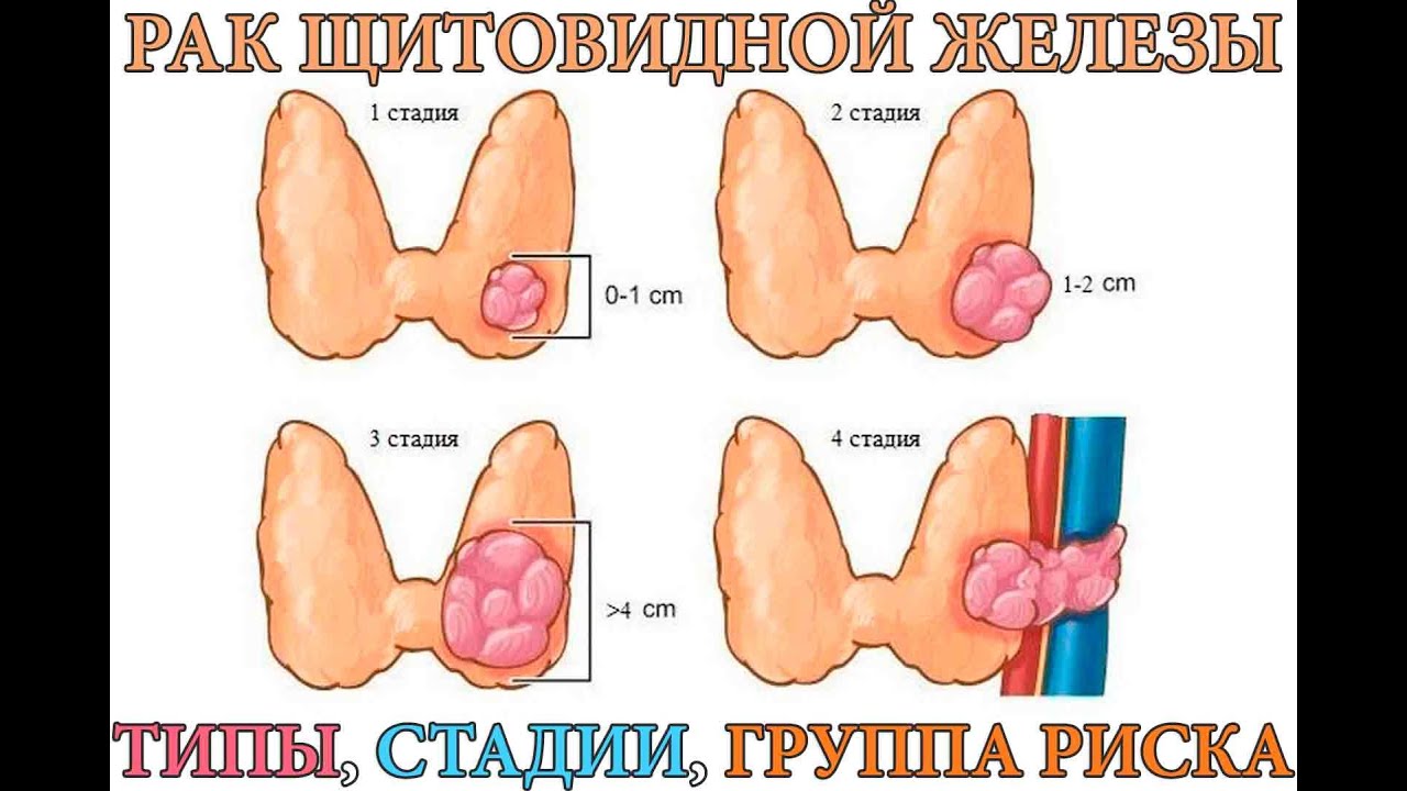 4 стадия злокачественная. Злокачественная опухоль щитовидной. Опухоль щитовиднойсжелезы. Карцинома щитовидной железы.