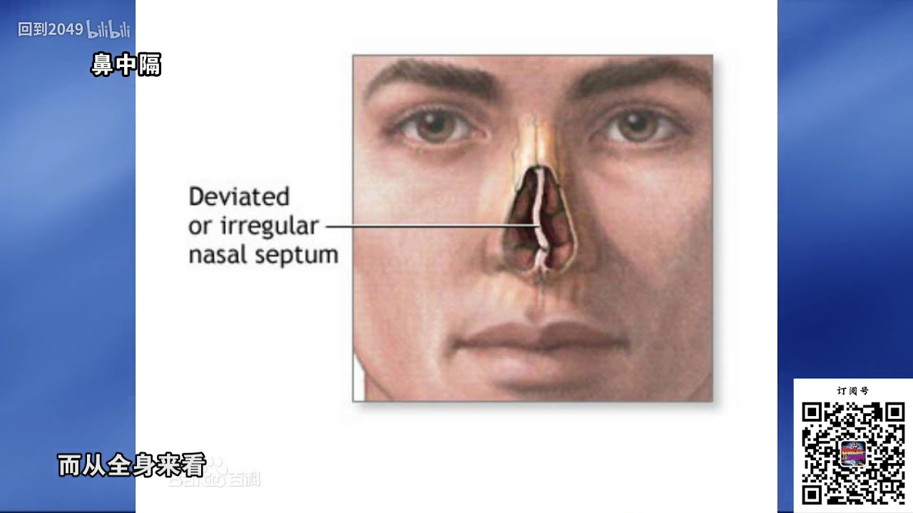 Болезни связанные с носом. Септопластика искривление носовой перегородки. Искривление носовой перегородки врожденная патология. Анатомия искривлённой носовой перегородки. Искривленная перегородка носа.