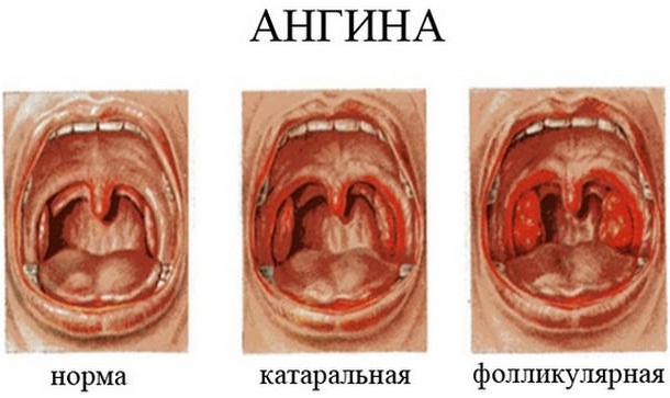 Увеличенные гланды у ребенка, но горло не болит. Фото, лечение, без операции