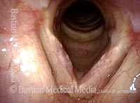 Patient with chronic hoarseness (1 of 4)