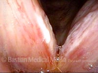 Candida laryngitis (2 of 4)