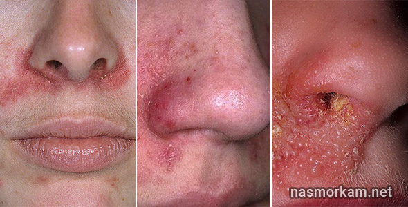 Красный нос: причины и лечение. Что делать при покраснении и воспалении