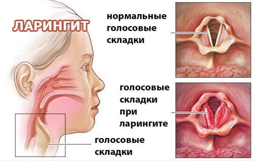Неприятные ощущения в горле: дискомфорт. Причины и лечение