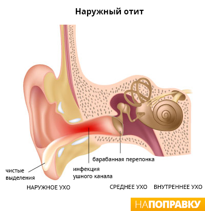 анатомия уха, симптомы наружного отита
