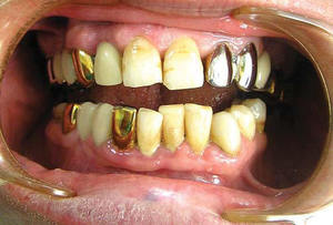 Гальваноз - это заболевание, характеризующееся возникновением электрических токов вследствие наличия металлических протезов в полости рта