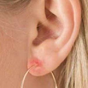 Почему шелушится кожа в ушах
