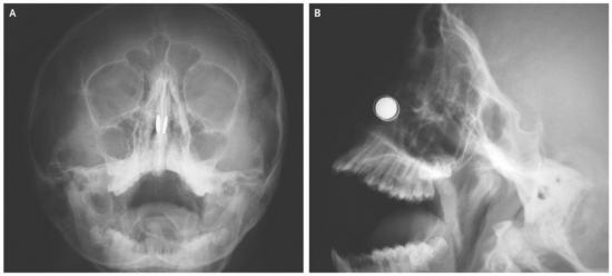 Перелом носа на рентгене