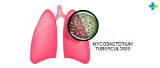 Туберкулез