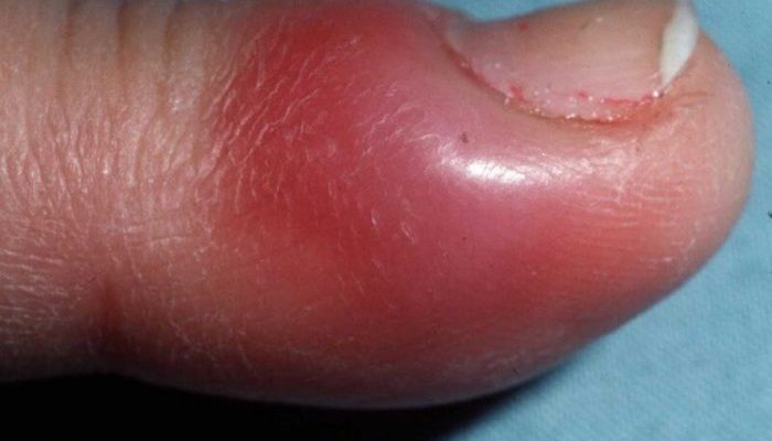 Как проявляется стафилококковая инфекция на коже? Способы лечения