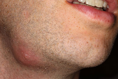 Абсцесс развивается при воспалении кожи на лице