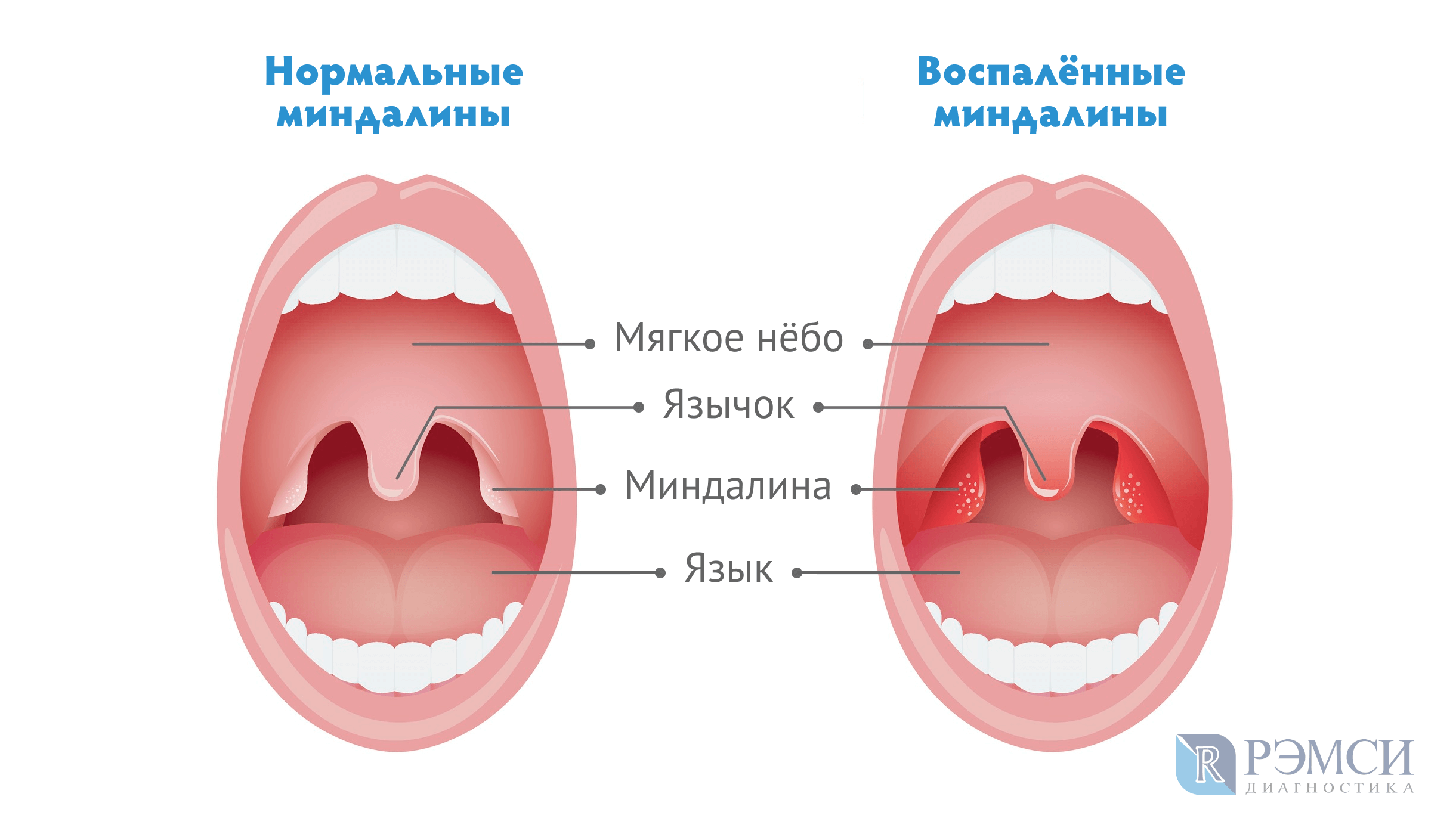 Схема горла в здоровом состоянии во время ангины
