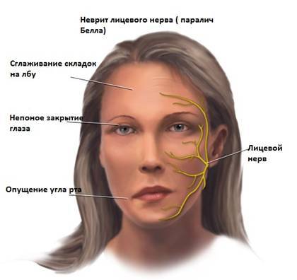 герпетическая невралгия лицевого нерва