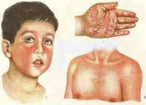 Мононуклеозная ангина у детей: симптомы и лечение