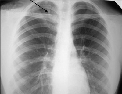 Очаговая пневмония на рендгеновском снимке