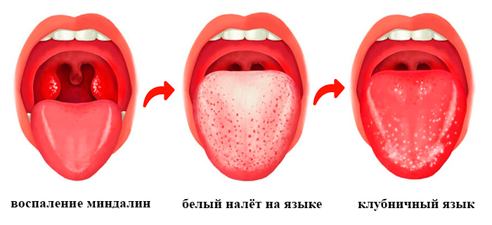миндалины и язык при скарлатине картинка