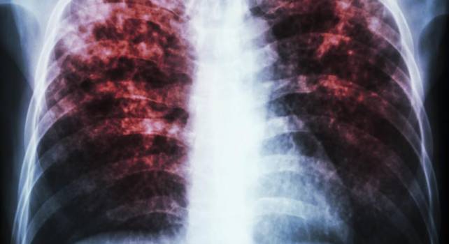воздушно капельным путем передается туберкулез