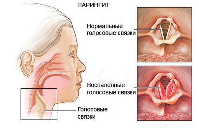 Лечение лающего кашля у взрослых